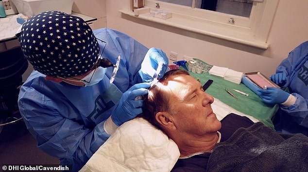 The procedure, called Direct Hair Implantation, involves removing hair from the back of the head