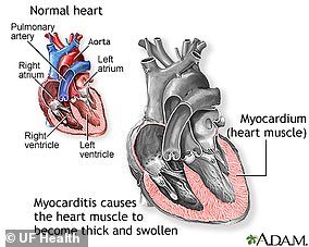 Myocarditis is an uncommon disorder. Most of the time, it is caused by an infection that reaches the heart