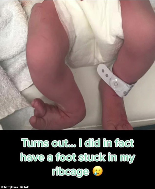 The woman, Bethany Love, posted on TikTok, where she said she didn't know what was causing the pain for a while, but when the baby was born she saw the clubfoot (pictured)