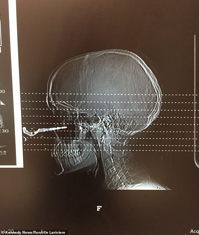 An X-ray showed how the key sank an inch and a half deep into his nasal cavity.