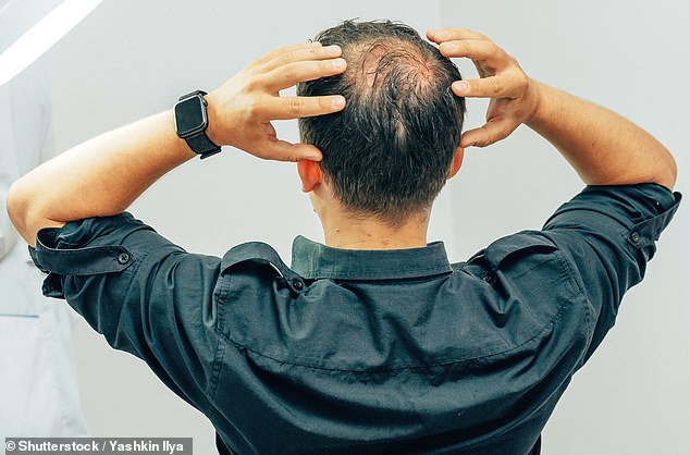 Male-pattern baldness is the most common type of hair loss, affecting 6.5 million men in the UK and more than 50 million in the US