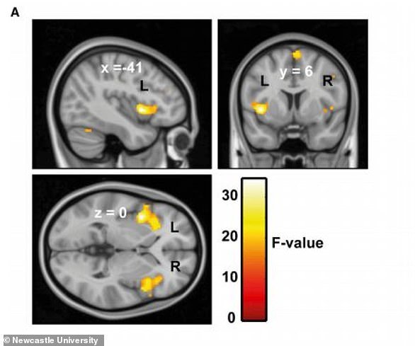 Scientists from the University of Newcastle discovered increased connectivity between the auditory cortex and motor control areas associated with the face, mouth and throat in people suffering from misophonia