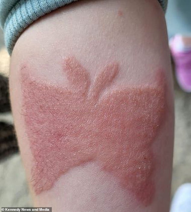 Despite initially looking good, the black henna tattoo (skin pictured after tattoo) became red and itchy after they returned home to Pudsey, West Yorkshire, resulting in two pharmacy visits.