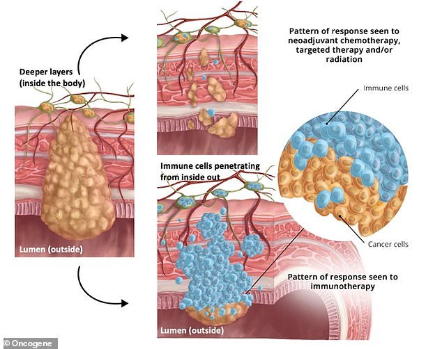 The image above shows a colorectal tumor being pushed out through the intestinal wall from the deeper layers of the colon.  This makes the tumor less likely to spread and can even 'destage' from stage 3 to stage 1