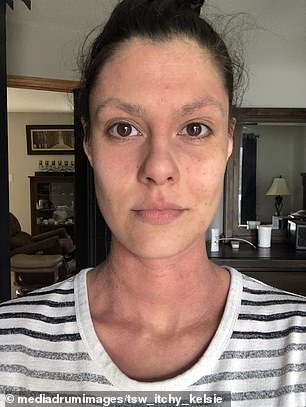 Here she is shown today after quitting the cream to take herbal remedies.  She also uses an antibody injection to curb inflammation