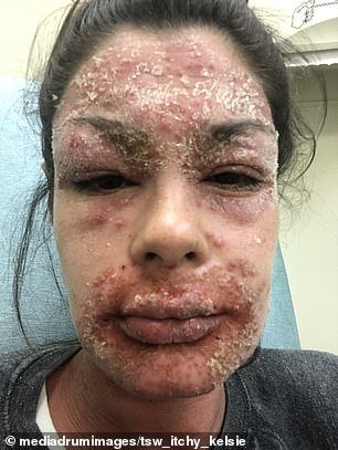 The photo above shows her face during a particularly bad flare-up