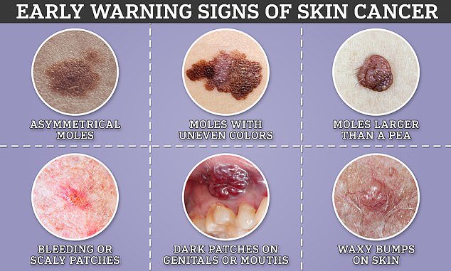 Signs of skin cancer range from harmless to obvious.  But experts warn that early treatment is crucial to ensure it does not spread or progress
