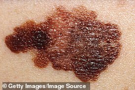 Melanoma now no longer the leading cause of skin cancer