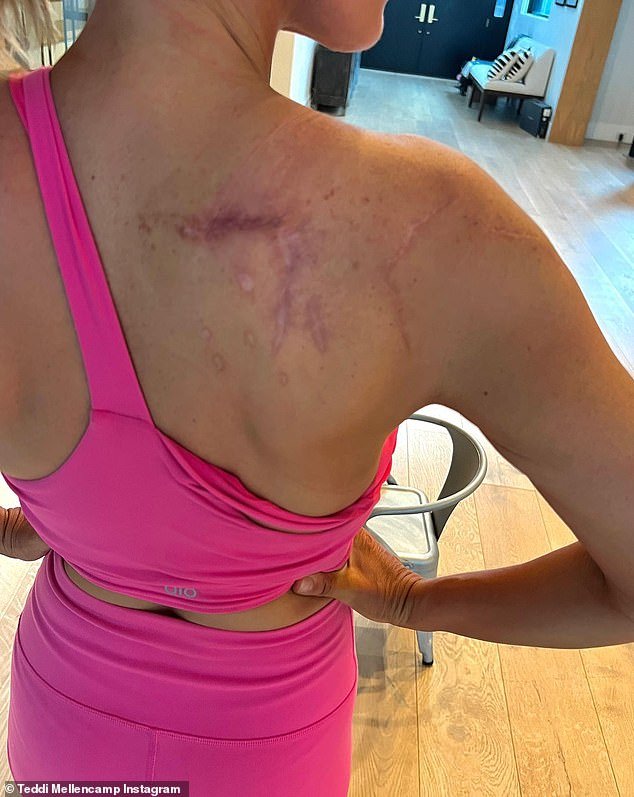 Discovery: Teddi discovered a new melanoma spot after having twelve of them removed in 2022.  Her boyfriend Kyle Richards initially pointed them out and had her see a doctor