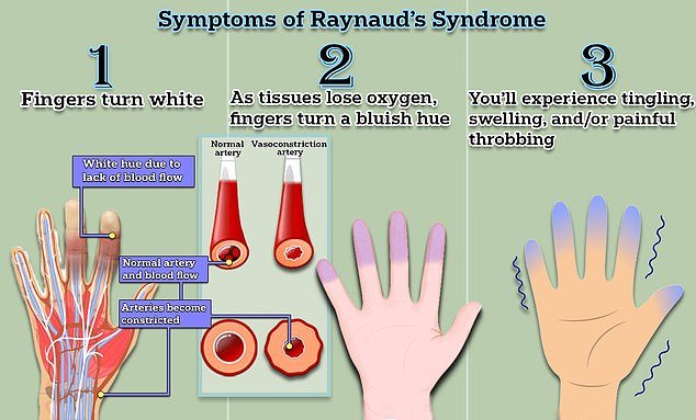 Raynaud's disease – which affects an estimated two to five percent of people – causes miniature spasms in the blood vessels, cutting off blood flow to the fingers and toes