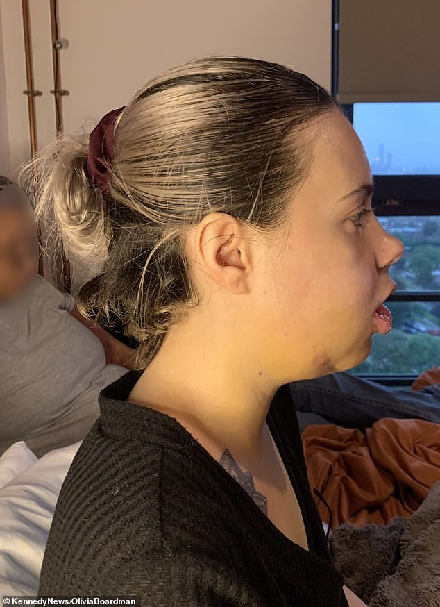 Olivia also had a genioplasty to change the position of her chin (photo: Olivia shortly after her surgery)