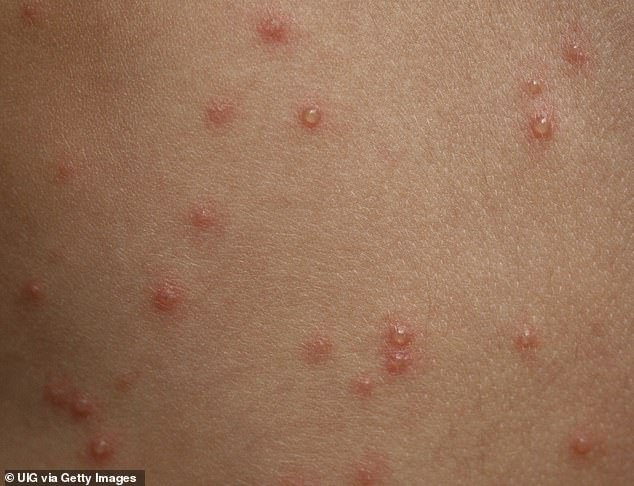 Chickenpox is caused by a virus called varicella-zoster, and it is normally a mild and relatively harmless illness that causes a rash
