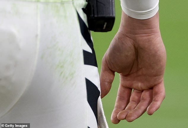Images showed that Burrow's hand had swollen significantly after his injury