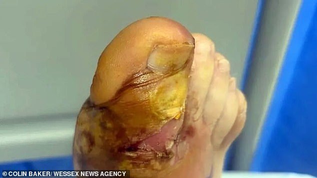 Colin's toe while in hospital in France.  He said medical staff cut his toe with a scalpel and milky pus came out