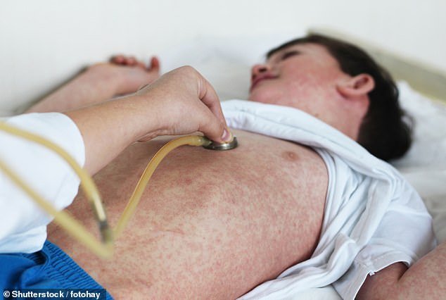 Experts are so concerned that they have issued new guidance for NHS staff when dealing with children with respiratory infections, urging them to 'think about measles'