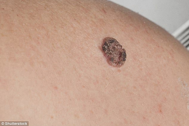 Melanoma kills around 2,300 people in Britain every year, while squamous cell carcinoma causes around 1,000 deaths