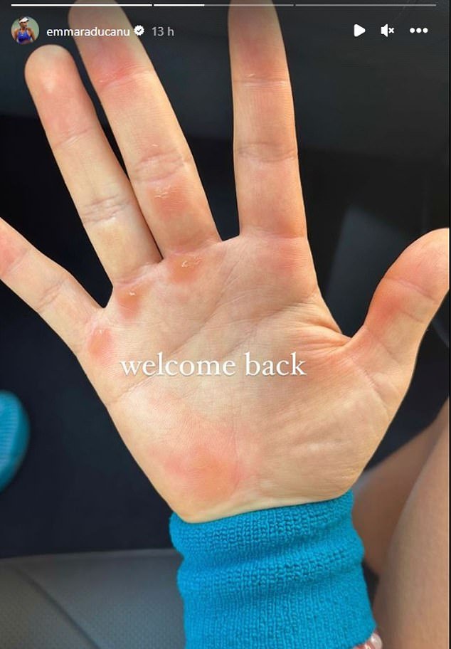Raducanu showed she was nearing a comeback by sharing a post of her blisters on her hands with the caption 