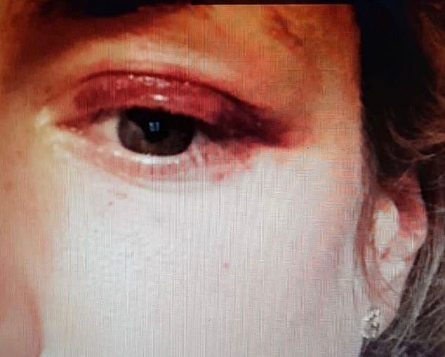 In one photo, she has what appears to be swelling and bruising under her eye