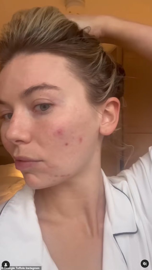 She previously revealed she 'lived in fear' that people would find out how bad her acne was at the height of her breakouts when she was younger