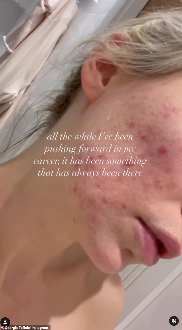 The former Made In Chelsea star, 29, has previously spoken about her 'all-consuming battle' with the skin condition