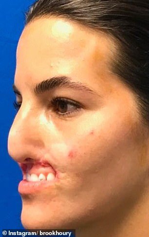 The model and skateboarder lost her upper lip due to a Pitbull attack (formerly)