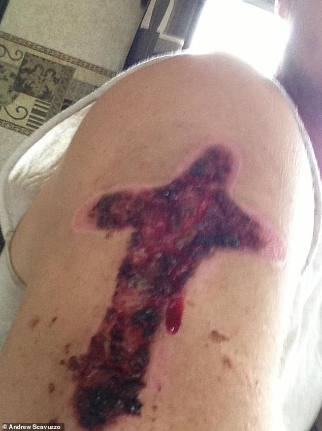 Scavuzzo claimed that two staff members branded his right arm in the shape of a cross with scorching metal