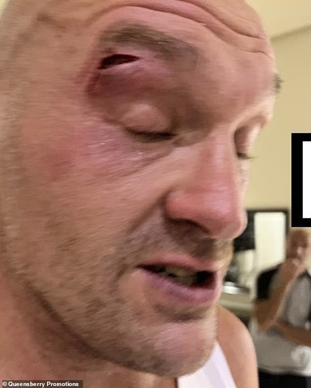 This is the nasty tear above Fury's right eye that has postponed the fight with Oleksandr Usyk