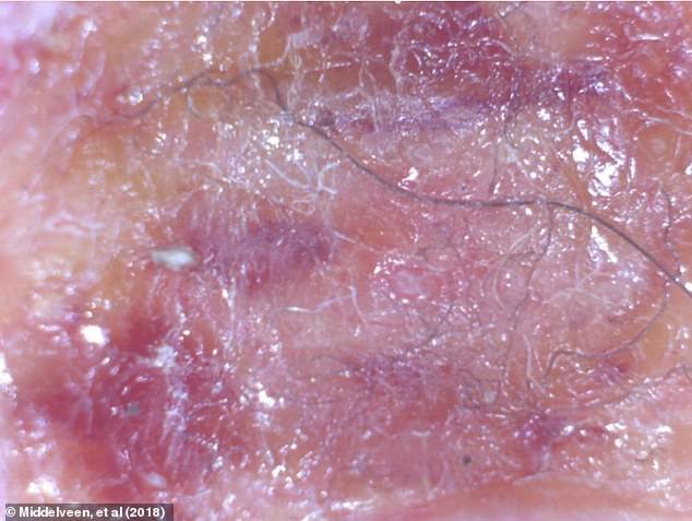 The above enlarged photo shows blue and white filaments embedded in the skin, from a 2018 study