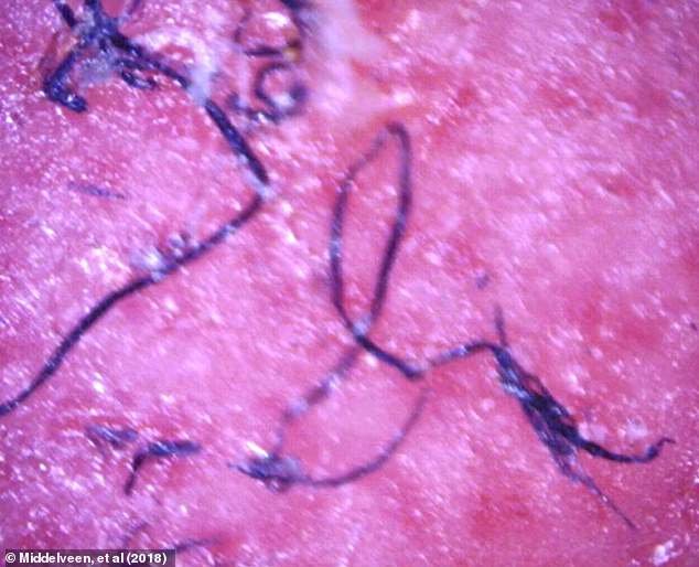 The above enlarged photo shows blue filaments embedded in the skin from a 2018 study