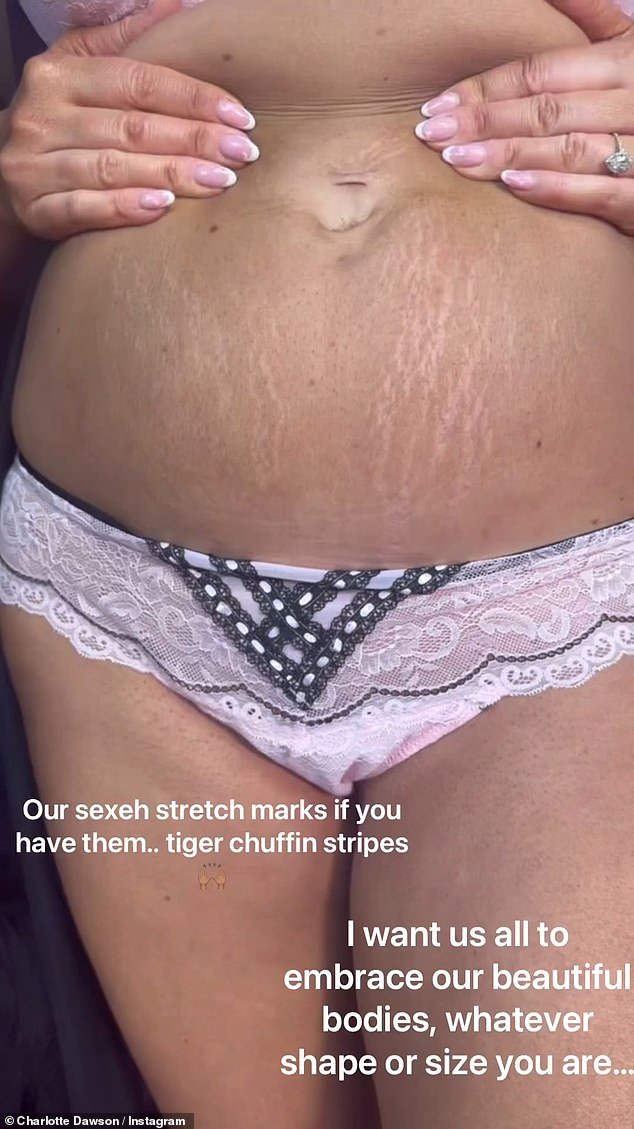 The star zoomed in to show people her stretch marks, or as she calls them 