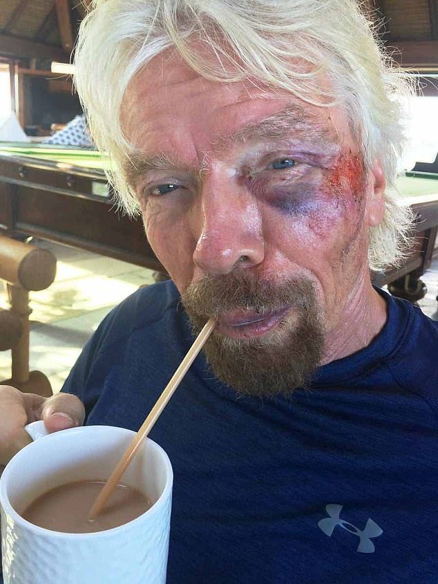 In 2016, Sir Richard broke his cheek and tore several ligaments while riding in the Virgin Strive challenge at Leverick Bay, forcing him to drink tea through a straw (pictured after the 2016 crash)
