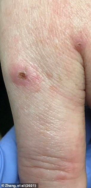 The photo above shows a lesion on the patient's hand from a 2021 case study