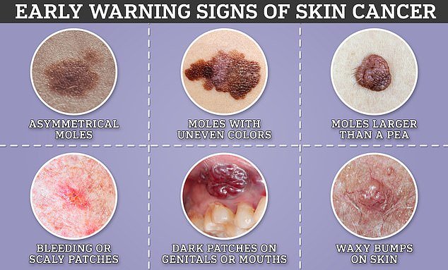 Signs of skin cancer range from harmless to obvious, but experts warn that treating cases early is crucial to ensure they don't spread or progress.