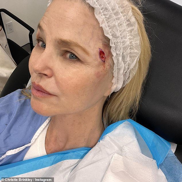 She also shared graphic photos of the wound on her face after the cancer was removed - as she urged fans to check their bodies regularly for any abnormalities.