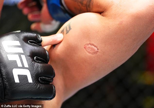 Lima shows off the gruesome bite wound he suffered during the flyweight fight in Las Vegas
