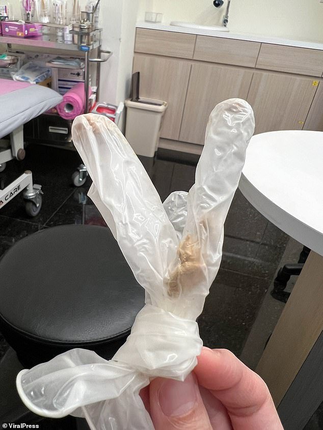 The medical professional peeled back the man's foreskin and saw the disgusting buildup of sickly yellow-brown smegma, seen here in a medical glove.