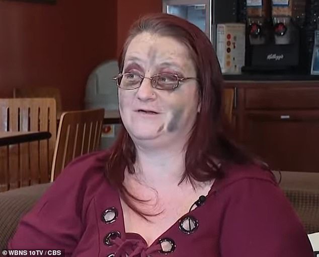 An Ohio mother has revealed the horrific bruises she suffered when a deadly tornado ripped through her home