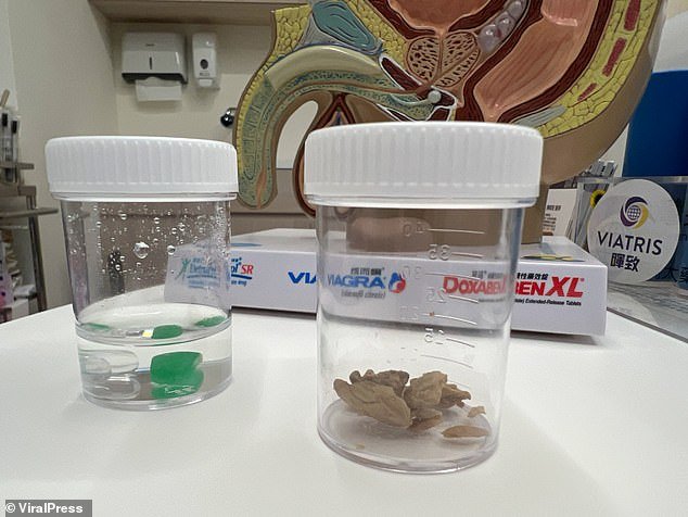 Doctors at the hospital collected the man's 30-year buildup of smegma and placed it in jars