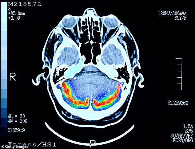 LIFE CHANGE: A brain scan of a patient with early-stage dementia