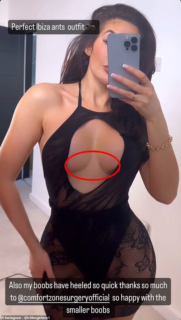 Chloe Ferry, 28, proudly showed off her corrective boob job scars on Instagram in a daring dress with a cut-out section