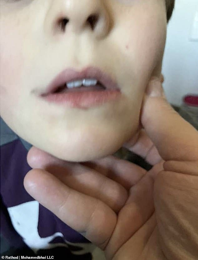 In photos released by the family's lawyer, the autistic child had severe bruising on his feet as a result of the March 18 incident, but further evidence shows he had suffered cuts on his lips and bruises on his neck two months earlier .