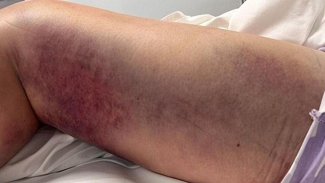 She has since relied on a wheelchair to get around, after photos showed her leg was severely bruised and swollen as a result of the snakebite