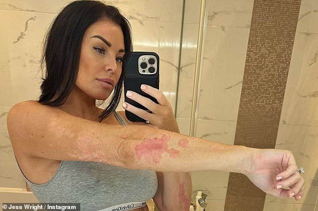 The former TOWIE star has previously detailed her frustration with the condition, as she regularly suffers 'painful' flare-ups on her skin