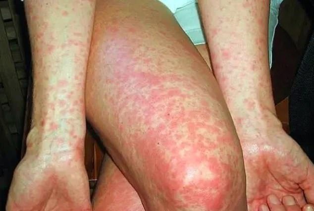 Symptoms of the disease include fever, loss of appetite, drowsiness, leg pain, lack of energy and seizures or convulsions, while younger people may develop a rash (pictured)