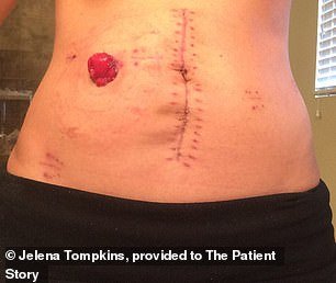 Ms Tompkins had 30 centimeters of her colon and rectum removed, as well as 17 lymph nodes, and was fitted with an ileostomy bag
