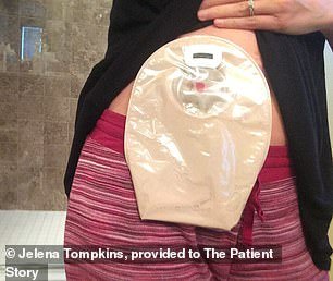 Ms Tompkins had 30 centimeters of her colon and rectum removed, as well as 17 lymph nodes, and was fitted with an ileostomy bag