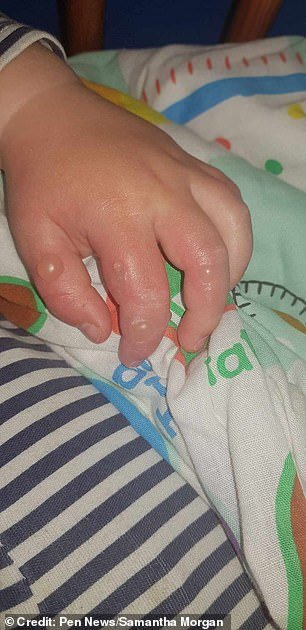 1714045189 836 Britains most dangerous plant hits Somerset toddler left with painful