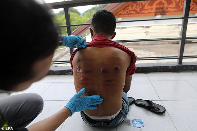 Injuries to a man's back are checked by a doctor after he was given up to 20 lashes for violating Sharia law