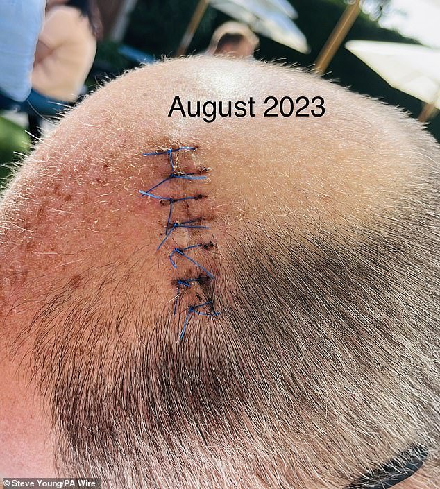 Mr. Young eventually had the melanoma removed.  Pictured here are the stitches he had last August