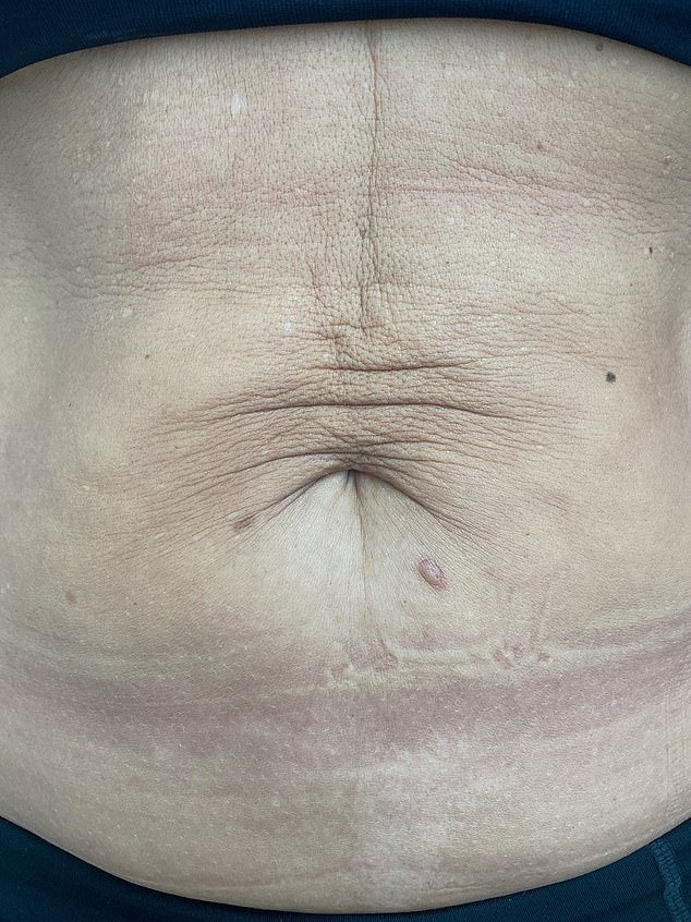 Women report that the £850 treatment produces remarkable results, erasing fine lines and sagging caused by ageing, sunbathing, weight loss and pregnancy.  In the photo: before the treatment